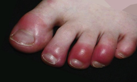 Covid toes 4